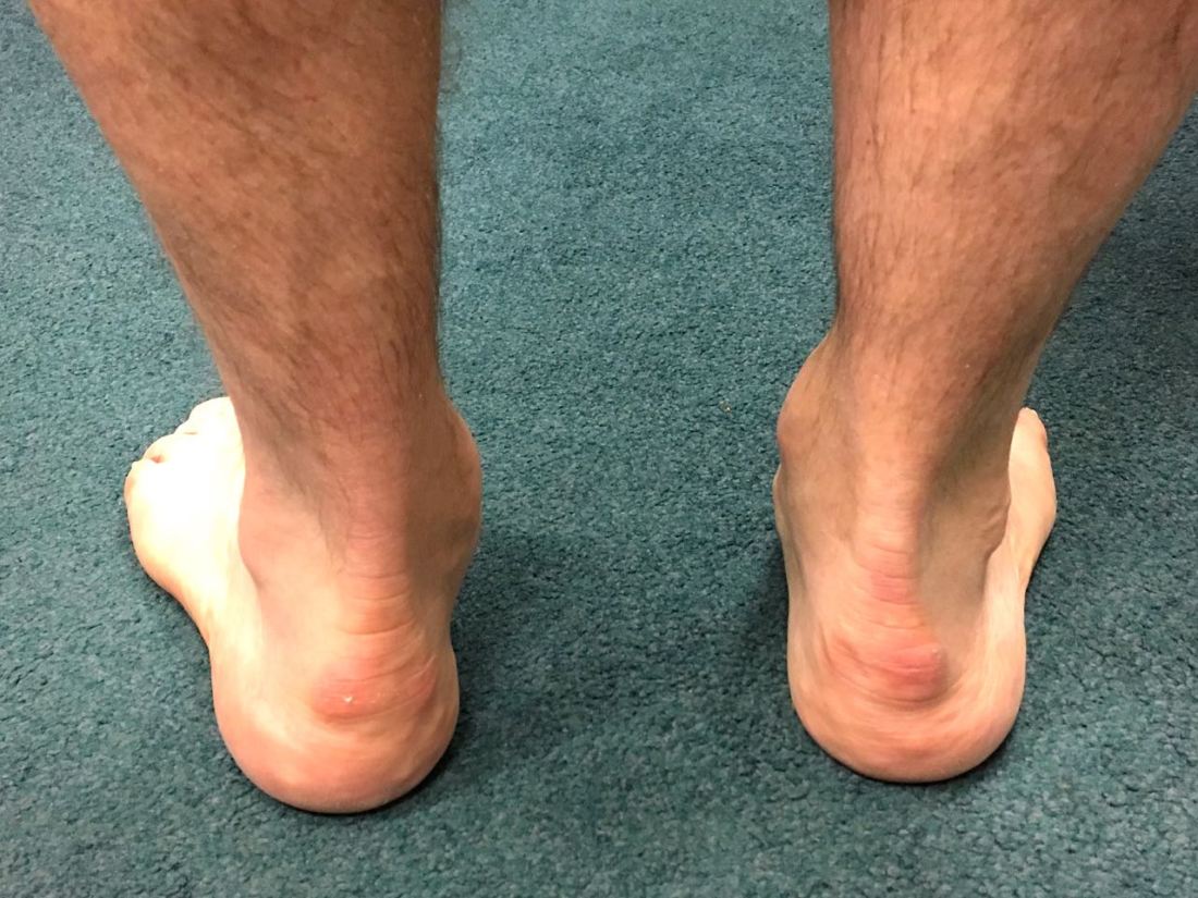 Too Many Toes sign (left foot)